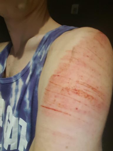 1st descent tree tap