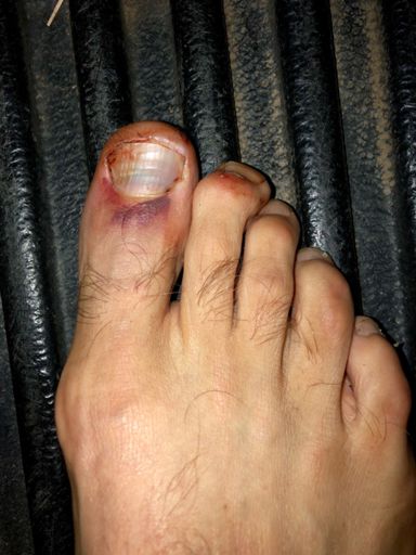 I don’t recommend smashing your toe with a glass table top 12 hours before doing this ride...