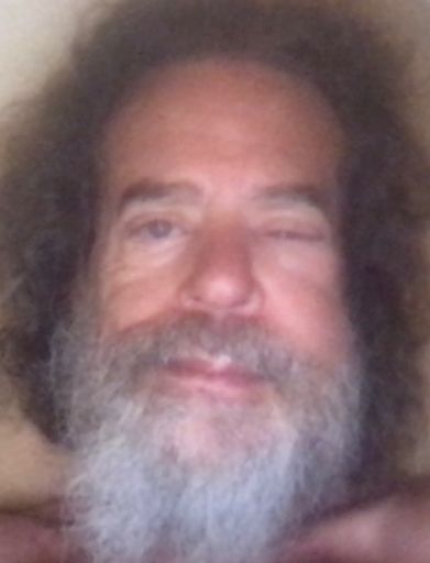 Tuesday morning, when my swelling was worst, I could barely open my left eye