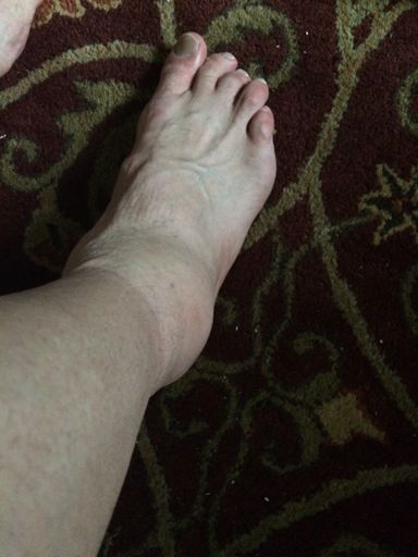 Nasty little tweak on the ankle, 2 weeks before the White Plains criterium dammit!!