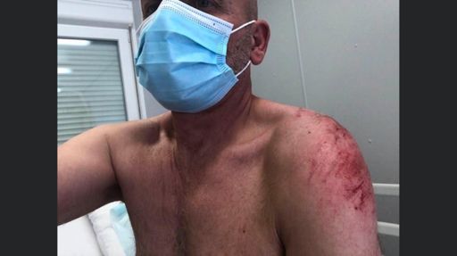 Fracture de la clavicule 😔😖