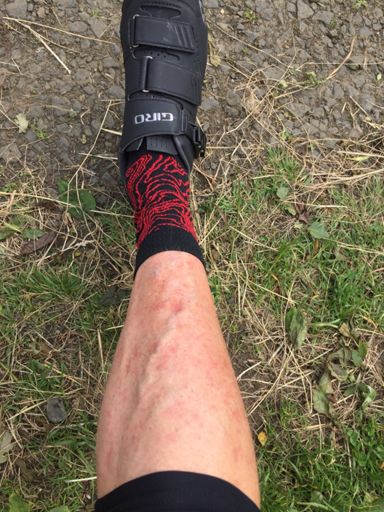 Nettle stings, I’ve missed you.... 🙈