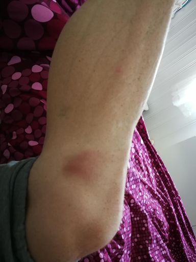 Merkelig blåmerke dukket opp under kneet der jeg fikk intens smerte igår. #HvordanFikkJegDet