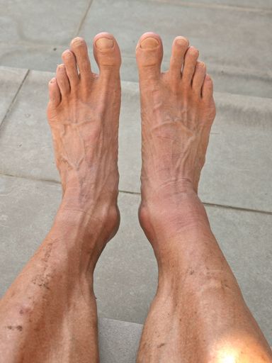 Swelling after the race, it has swelled up a bunch more now, wearing multiple layers of compression..