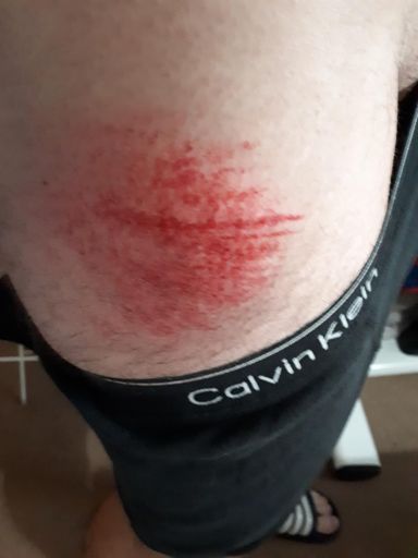 Good old road rash !! Stings like a bitch