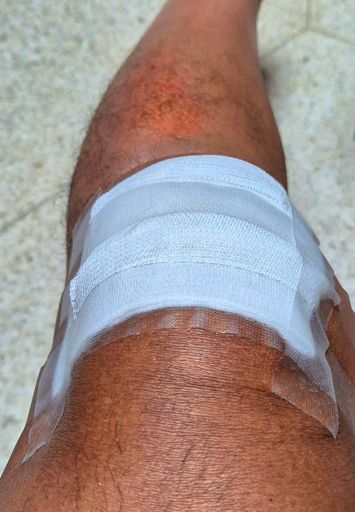 Had my left knee patched up. Applied some antibiotic ointment so the wounds would heal faster, hopefully 🙏