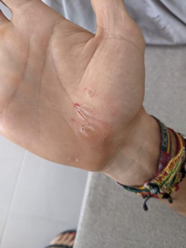 Mala costumbre la mía de no usar guantes!!!