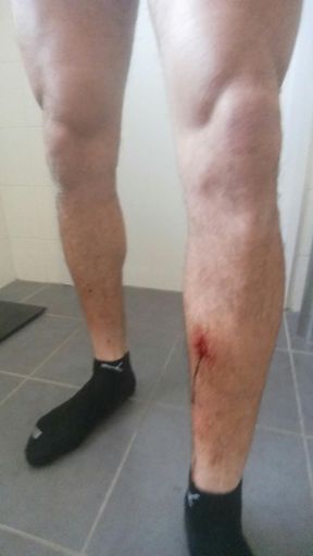 This is from the pedal struck my leg.