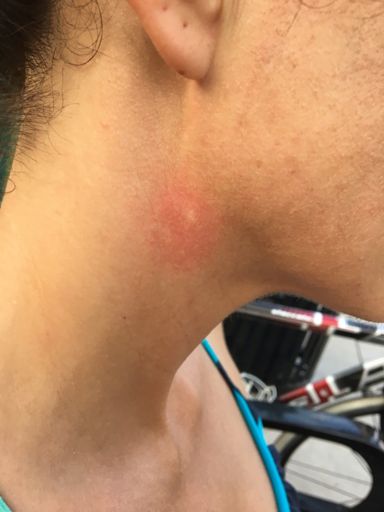 Heidi gets a bee sting....IN THE NECK!