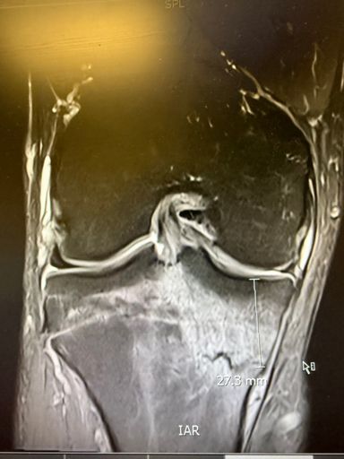 Broken TIBIA September 2025