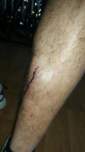 One of my MANY injuries from this ride that I sustained.