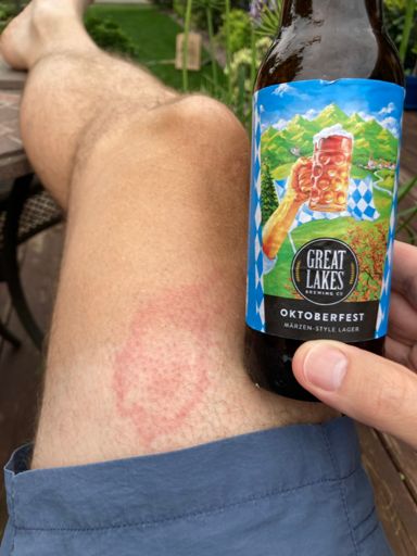 Bee stings and beer