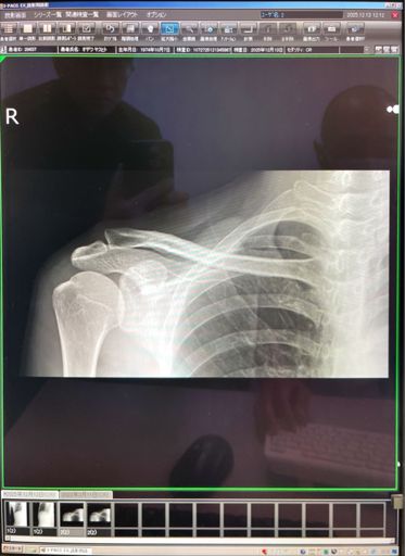 肩の亜脱臼の写真。痛みは≒3週間続いたけど、今は完治