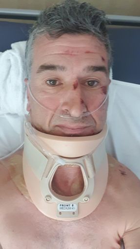 Day 1 post accident.