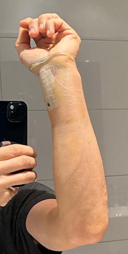 Enkele dagen na operatie pols elleboog 12 Januari