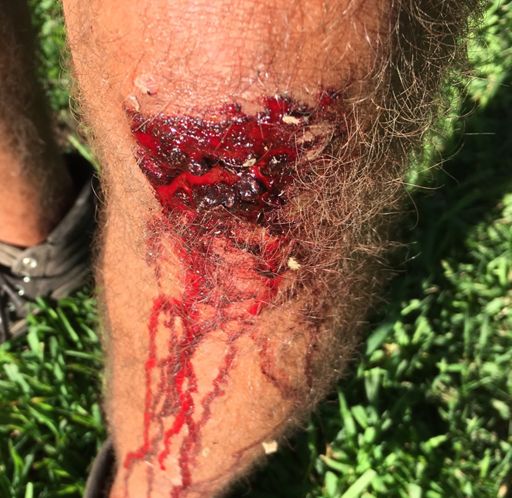 Time to go get stitches