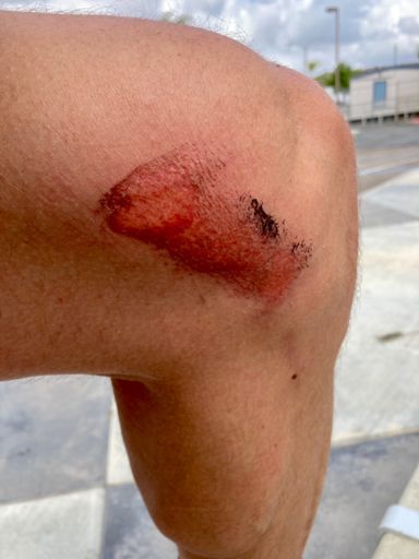 Obligatory wound photo